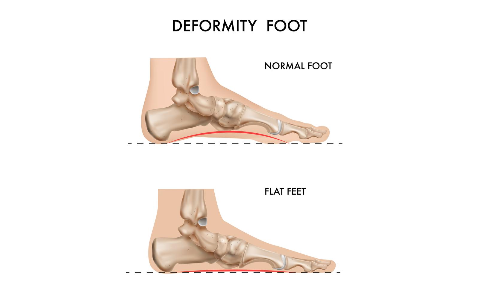 Realistic Bones Anatomy Foot Arch Deformation 201230514 Vector Illustration Concept