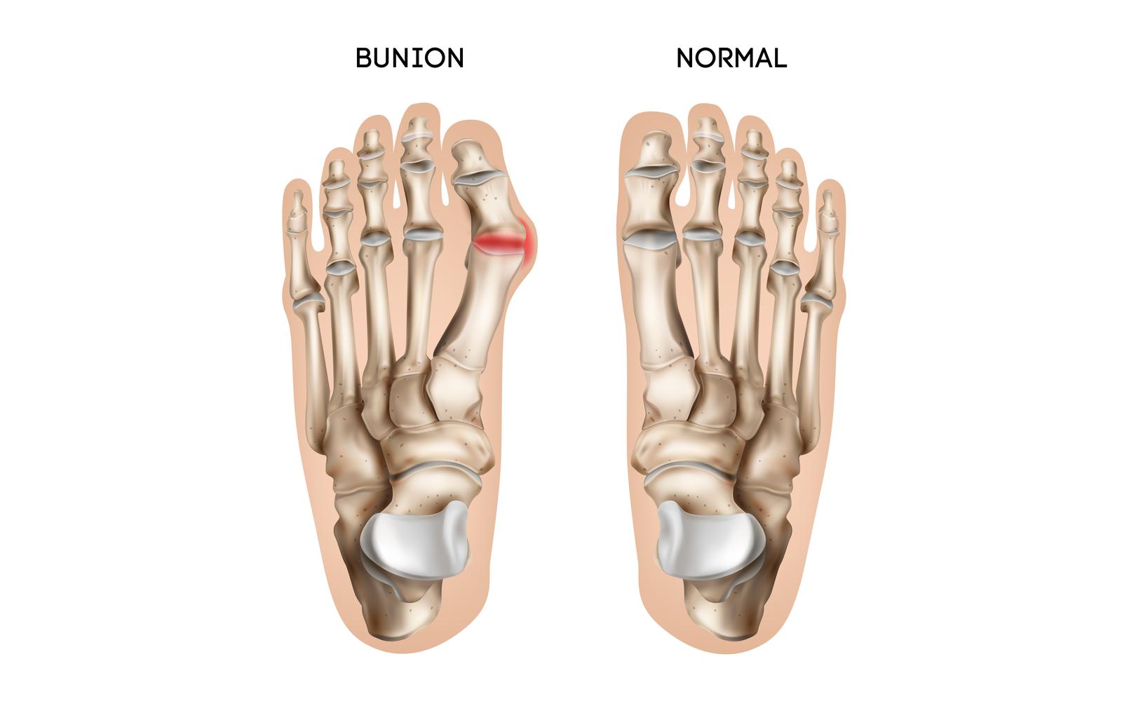 Realistic Bunion Foot 201230515 Vector Illustration Concept