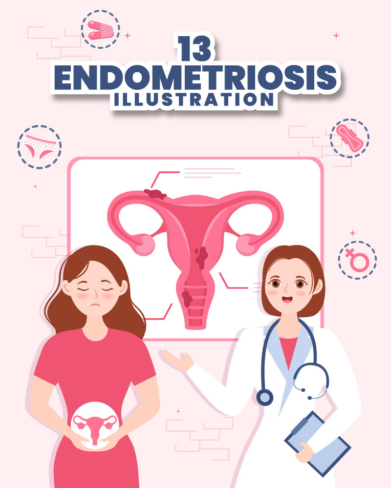 13 Endometriosis Illustration